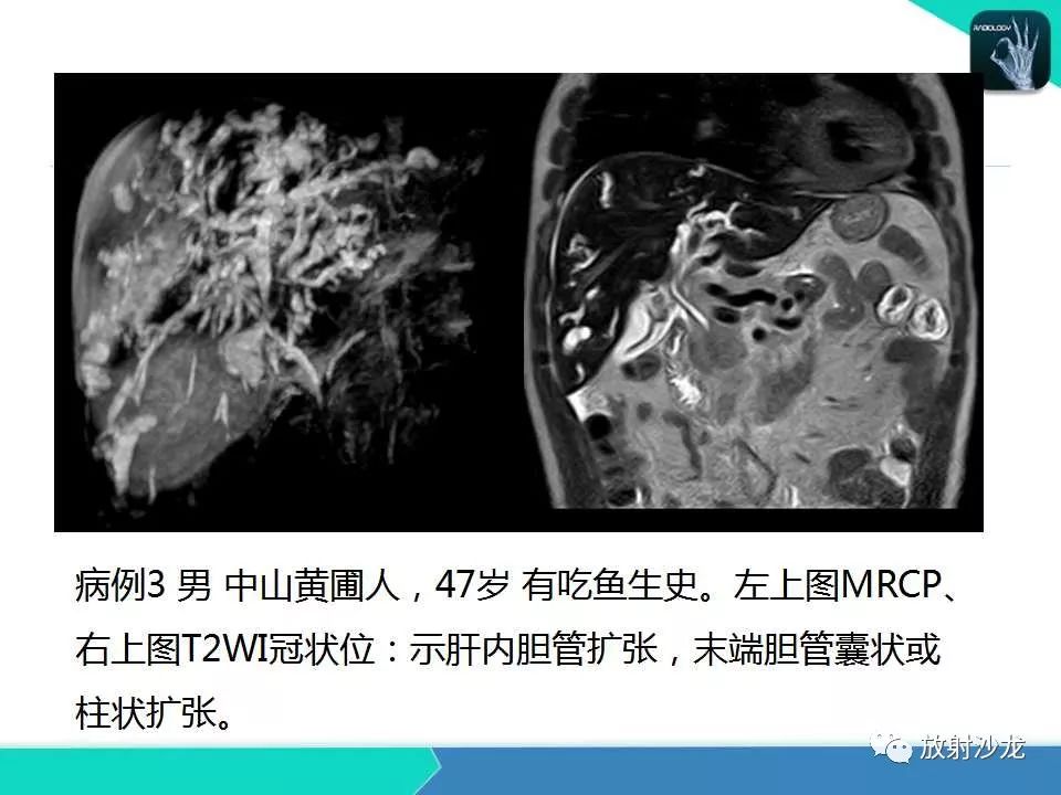 【PPT】肝吸虫性胆管炎的影像诊断