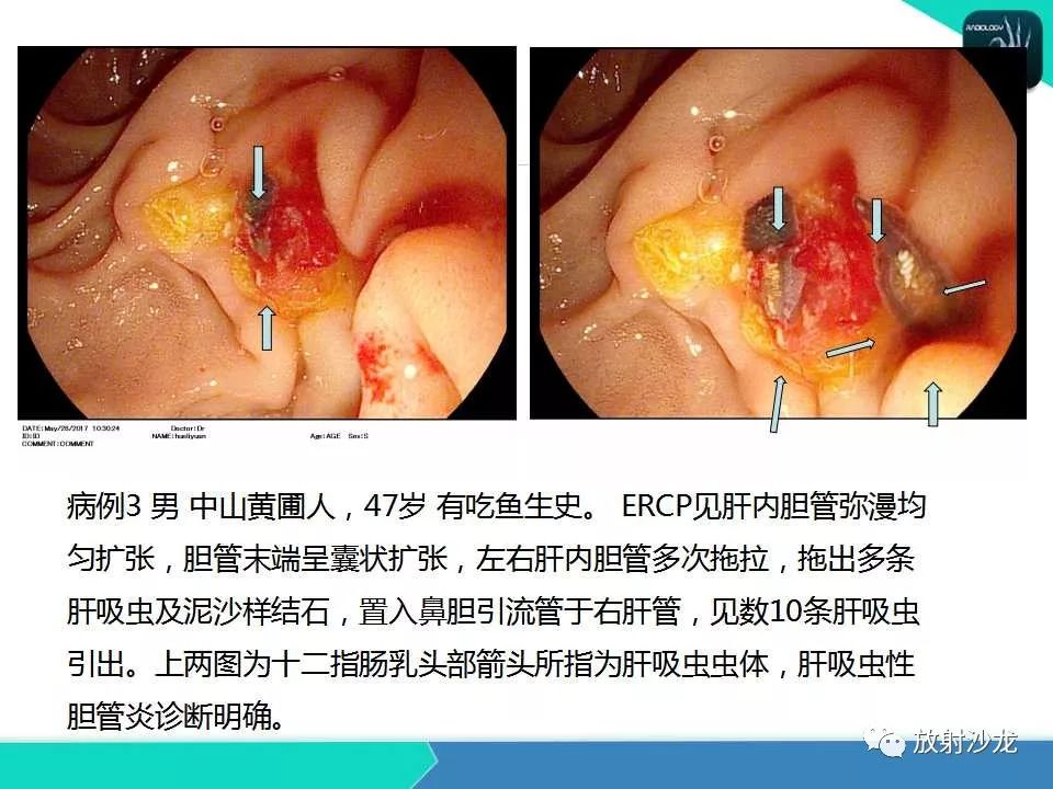 【PPT】肝吸虫性胆管炎的影像诊断