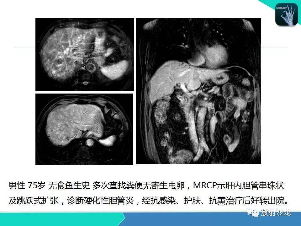 【PPT】肝吸虫性胆管炎的影像诊断
