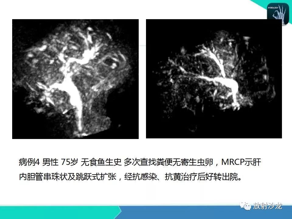 【PPT】肝吸虫性胆管炎的影像诊断