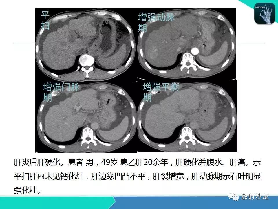 【PPT】肝吸虫性胆管炎的影像诊断