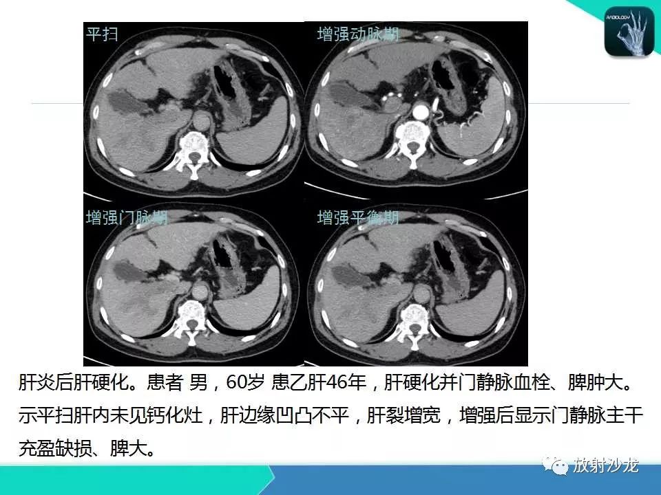 【PPT】肝吸虫性胆管炎的影像诊断