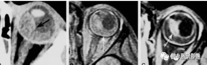 【病例】视网膜母细胞瘤1例CT影像表现 【病例】视网膜母细胞瘤1例CT影像表现