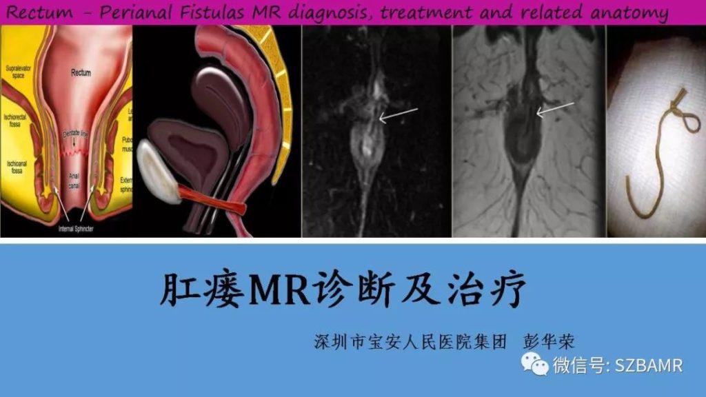 【PPT】肛瘘MR诊断及治疗