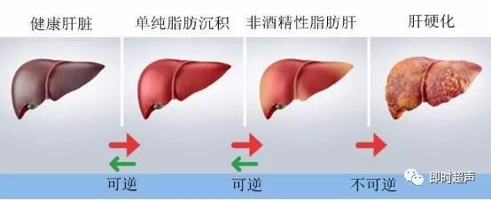 脂肪肝,常见却也不容易 脂肪肝,常见却也不容易