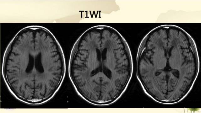 【病例】肾上腺脑白质营养不良1例MR影像诊断分析