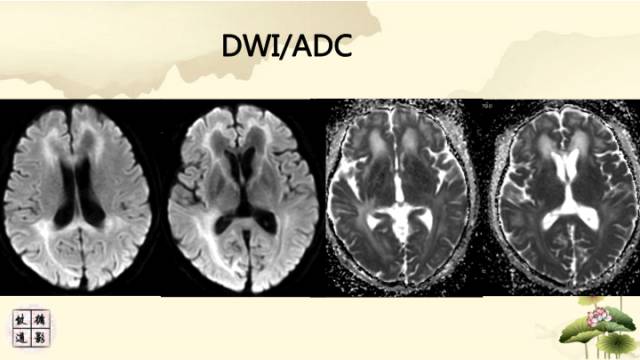 【病例】肾上腺脑白质营养不良1例MR影像诊断分析