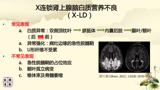 【病例】肾上腺脑白质营养不良1例MR影像诊断分析