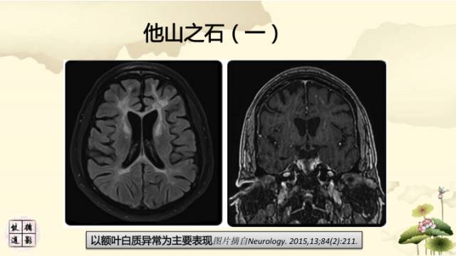 【病例】肾上腺脑白质营养不良1例MR影像诊断分析