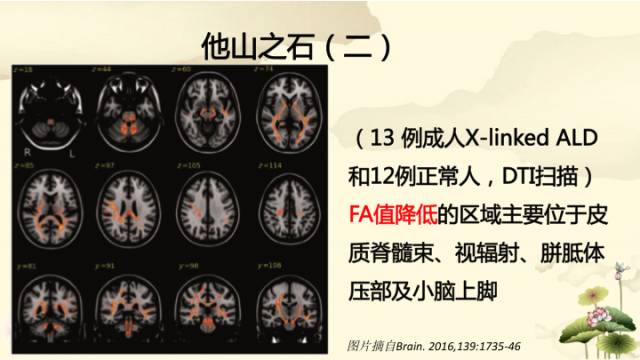 【病例】肾上腺脑白质营养不良1例MR影像诊断分析
