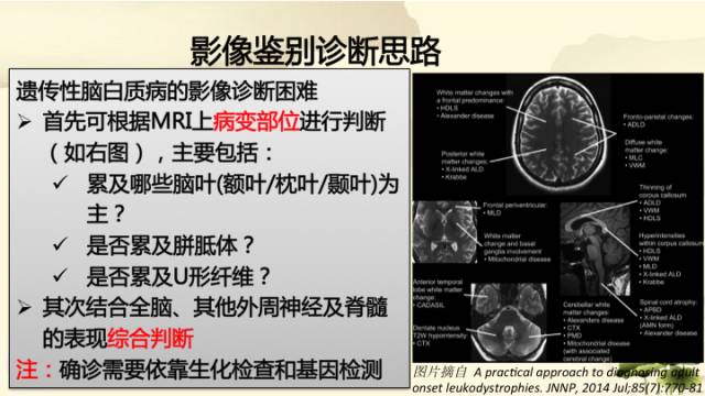 【病例】肾上腺脑白质营养不良1例MR影像诊断分析
