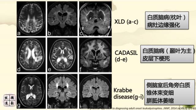 【病例】肾上腺脑白质营养不良1例MR影像诊断分析