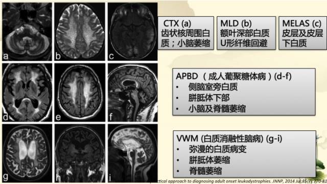 【病例】肾上腺脑白质营养不良1例MR影像诊断分析