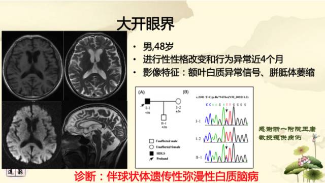 【病例】肾上腺脑白质营养不良1例MR影像诊断分析