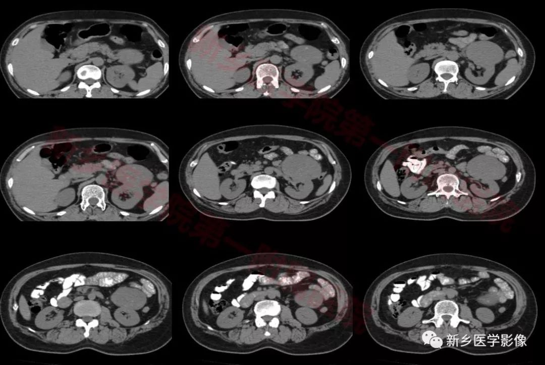 【病例】左肾嫌色细胞癌1例CT