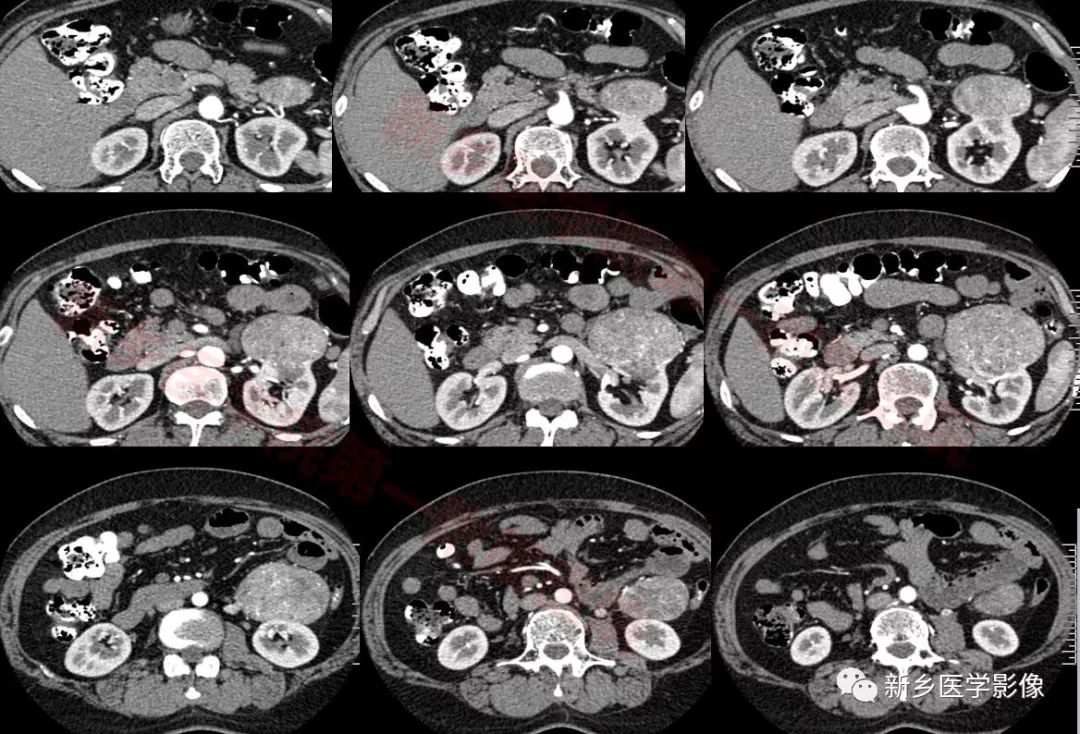 【病例】左肾嫌色细胞癌1例CT