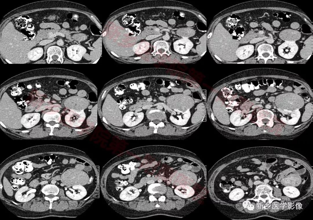 【病例】左肾嫌色细胞癌1例CT