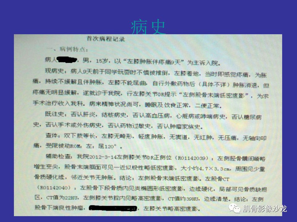 【病例】骨的纤维结构不良(骨纤维异常增殖症)一例X线CT及MR 【病例】骨的纤维结构不良(骨纤维异常增殖症)一例X线CT及MR