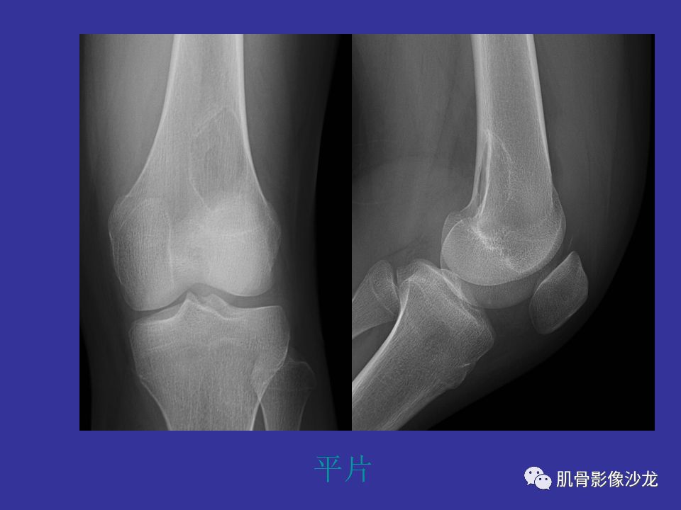 【病例】骨的纤维结构不良(骨纤维异常增殖症)一例X线CT及MR 【病例】骨的纤维结构不良(骨纤维异常增殖症)一例X线CT及MR