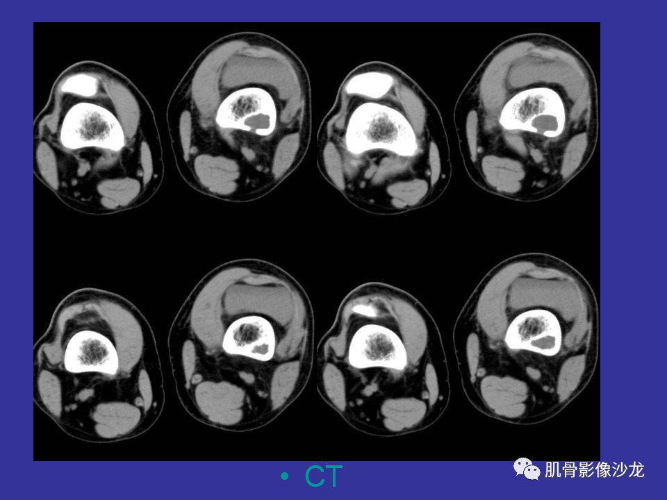 【病例】骨的纤维结构不良(骨纤维异常增殖症)一例X线CT及MR 【病例】骨的纤维结构不良(骨纤维异常增殖症)一例X线CT及MR