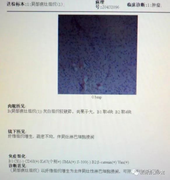 【病例】骨的纤维结构不良(骨纤维异常增殖症)一例X线CT及MR 【病例】骨的纤维结构不良(骨纤维异常增殖症)一例X线CT及MR