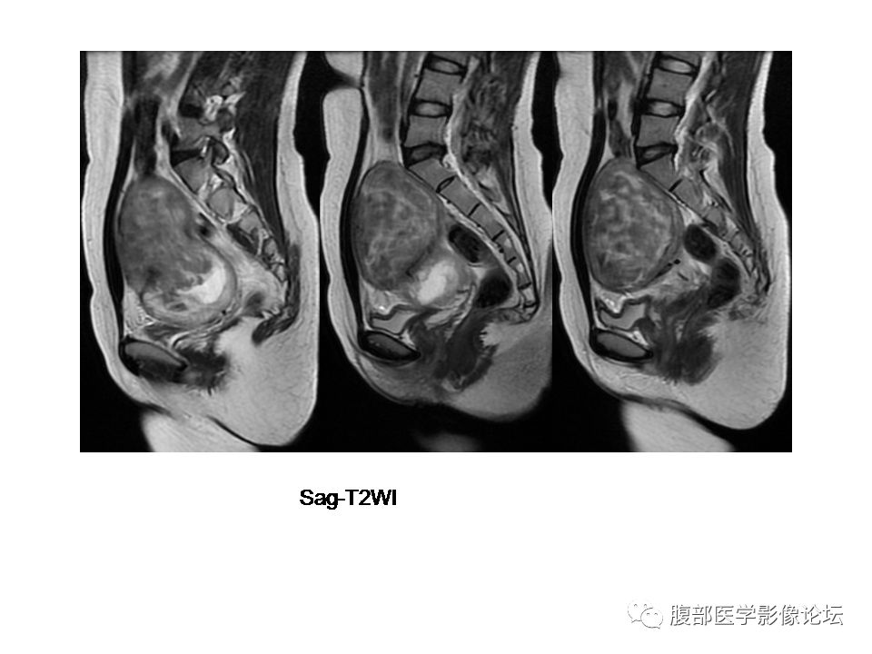 【病例】巨大子宫肌瘤1例MR