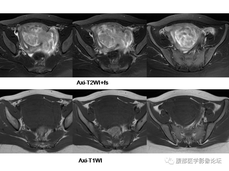 【病例】巨大子宫肌瘤1例MR 【病例】巨大子宫肌瘤1例MR