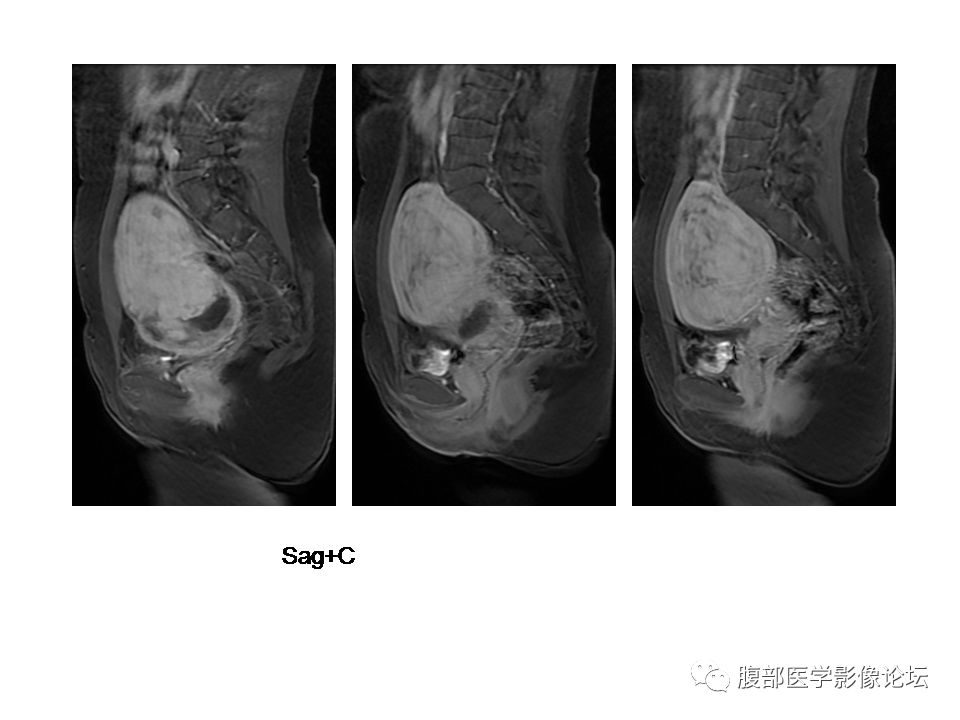 【病例】巨大子宫肌瘤1例MR 【病例】巨大子宫肌瘤1例MR