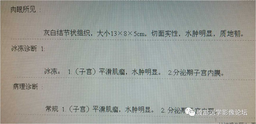 【病例】巨大子宫肌瘤1例MR 【病例】巨大子宫肌瘤1例MR