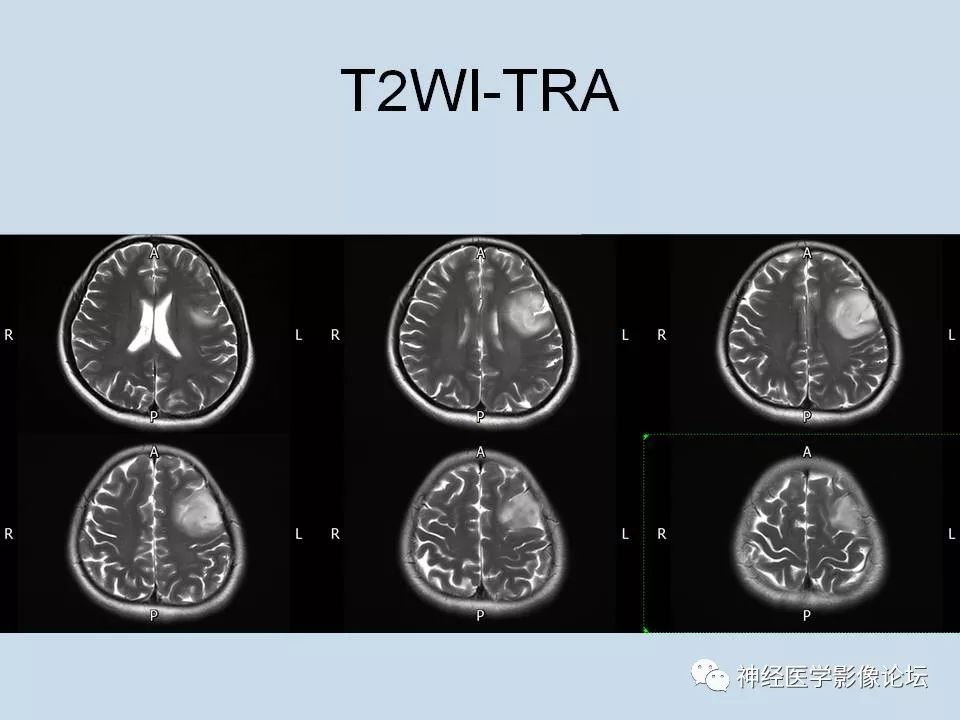 【病例】少突胶质细胞瘤1例MR