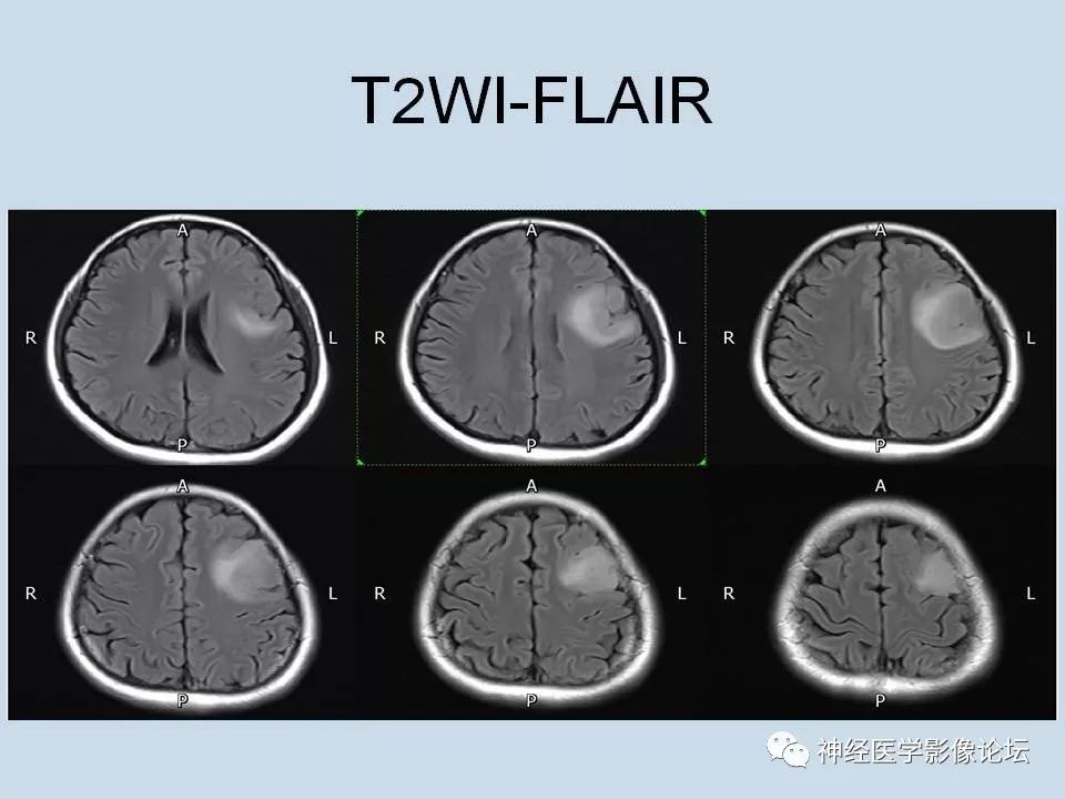 【病例】少突胶质细胞瘤1例MR