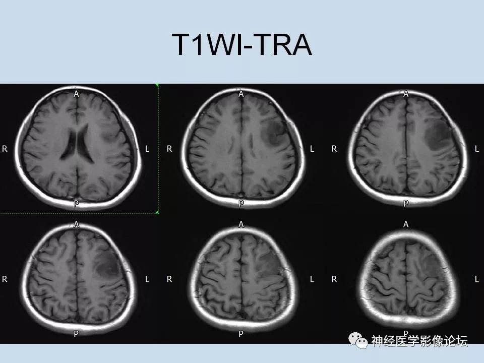 【病例】少突胶质细胞瘤1例MR