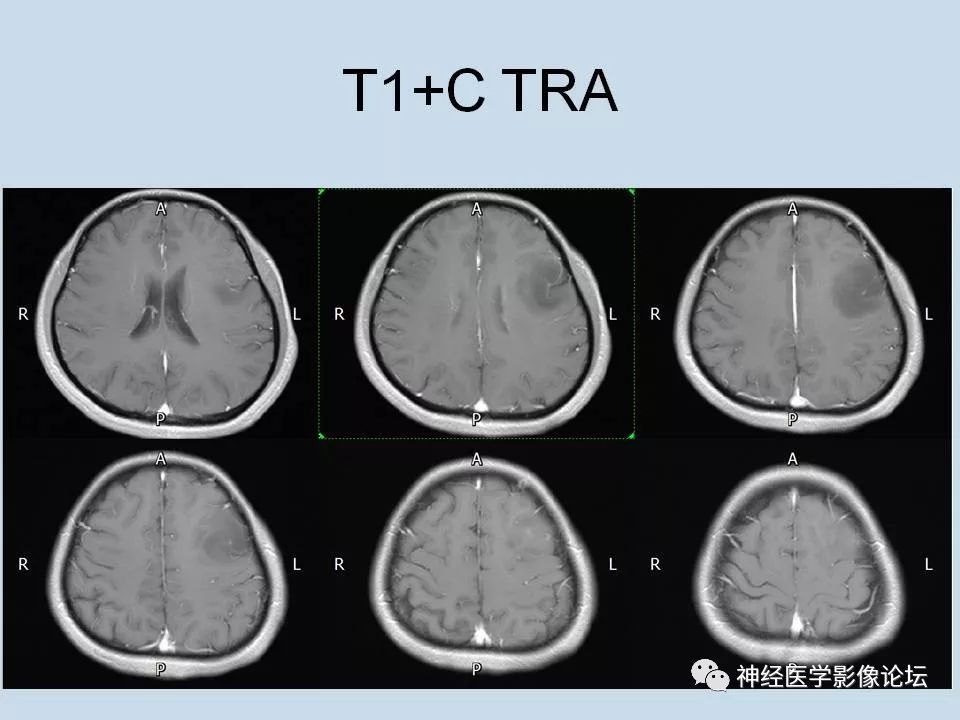 【病例】少突胶质细胞瘤1例MR