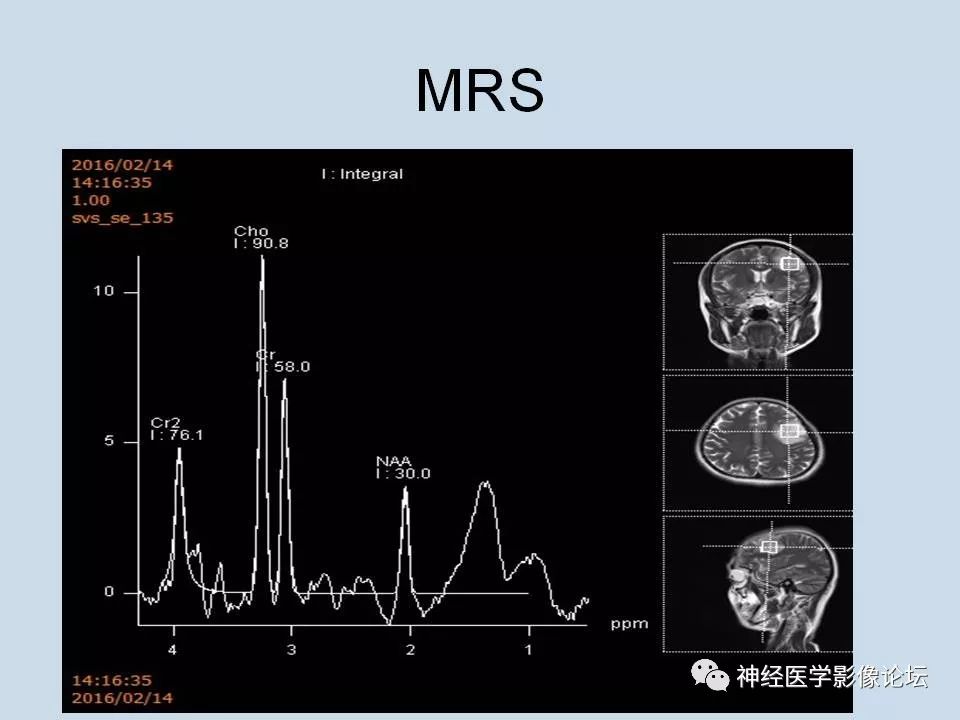 【病例】少突胶质细胞瘤1例MR