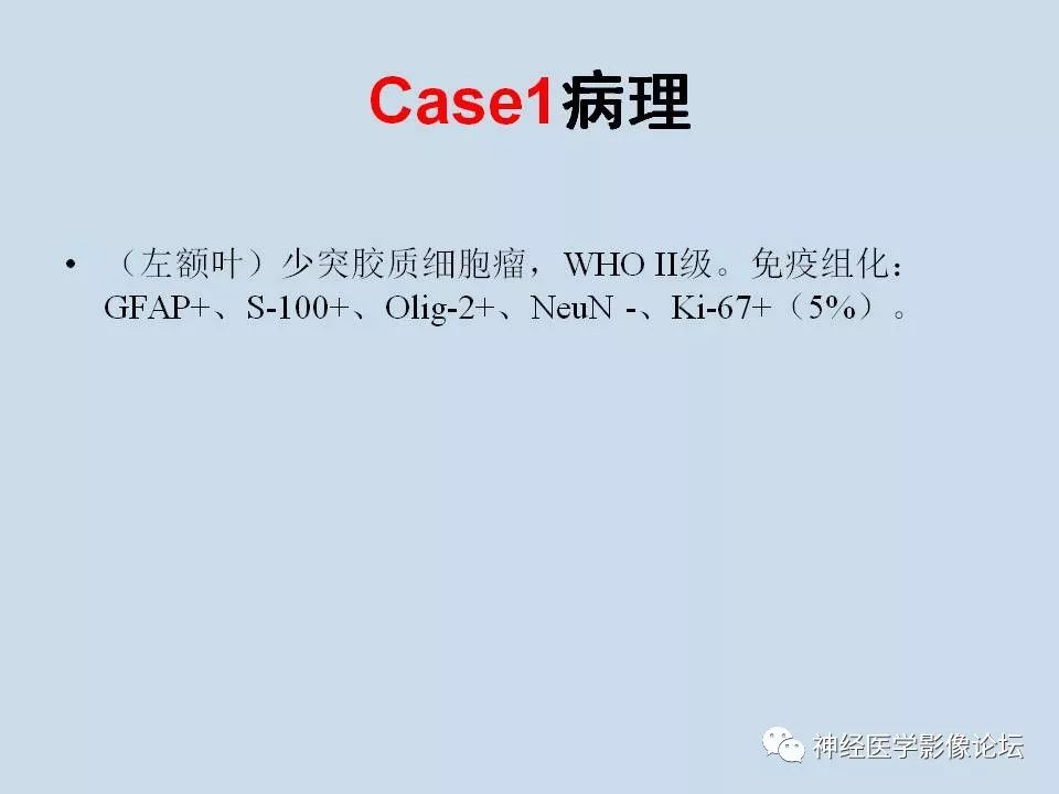 【病例】少突胶质细胞瘤1例MR