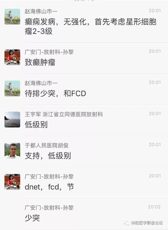 【病例】少突胶质细胞瘤1例MR