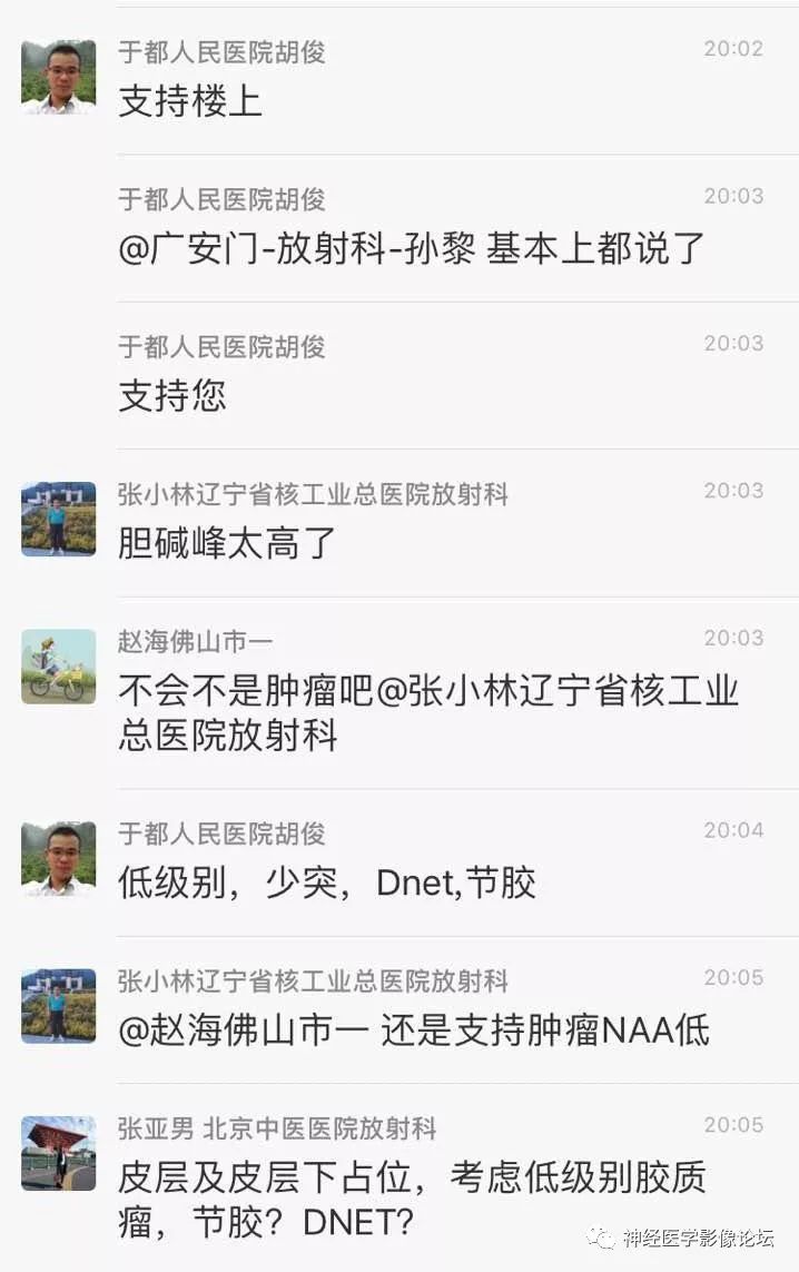 【病例】少突胶质细胞瘤1例MR
