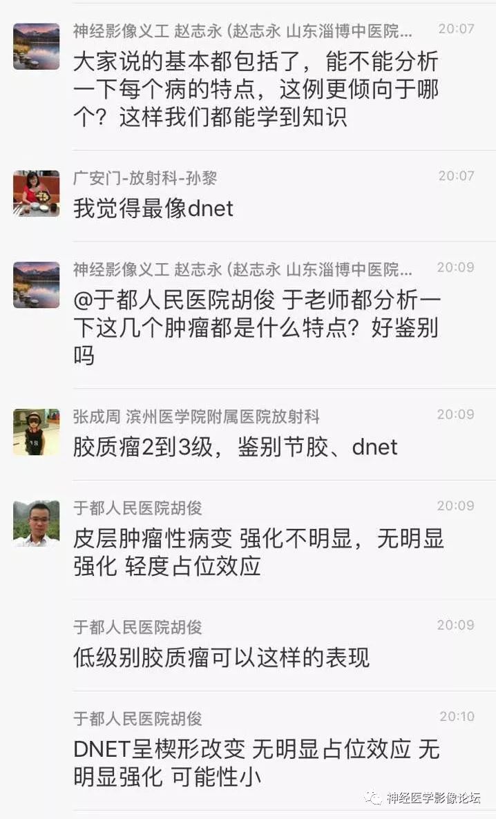 【病例】少突胶质细胞瘤1例MR