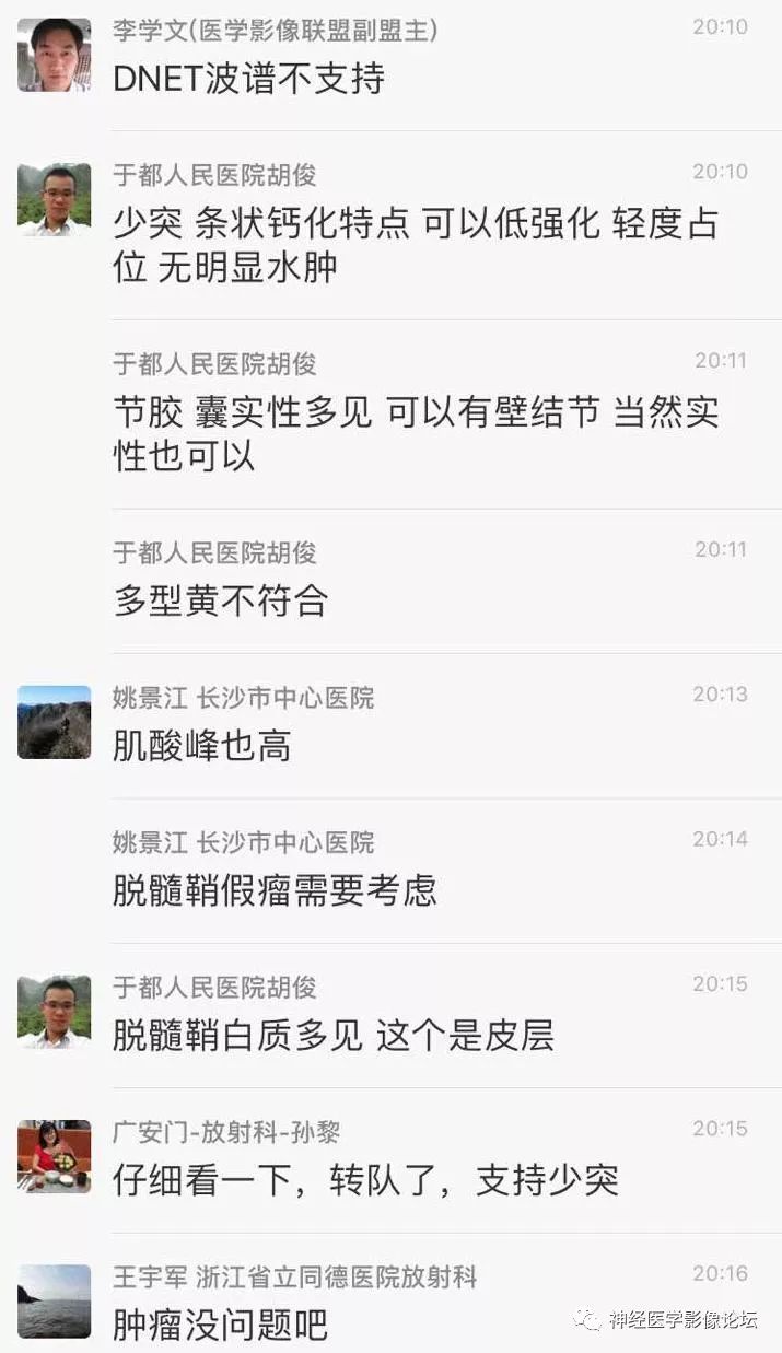 【病例】少突胶质细胞瘤1例MR