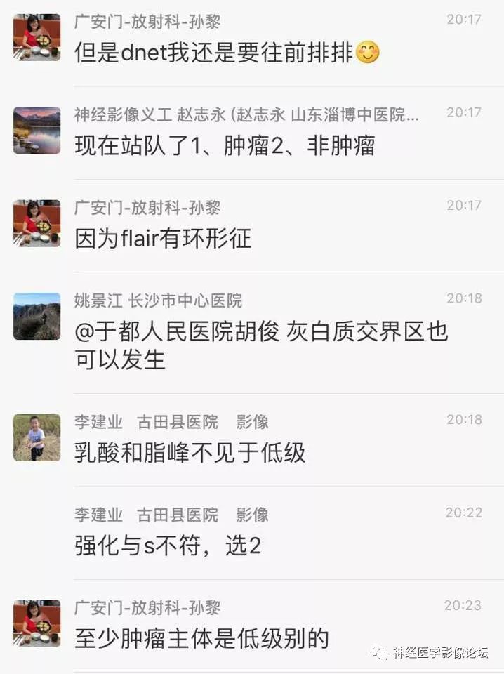 【病例】少突胶质细胞瘤1例MR