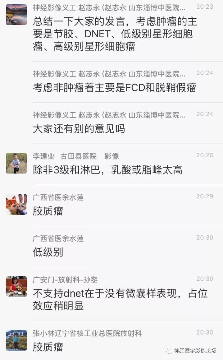 【病例】少突胶质细胞瘤1例MR