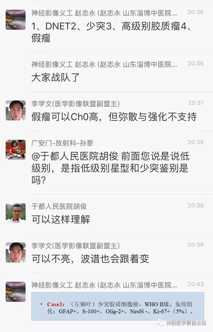 【病例】少突胶质细胞瘤1例MR