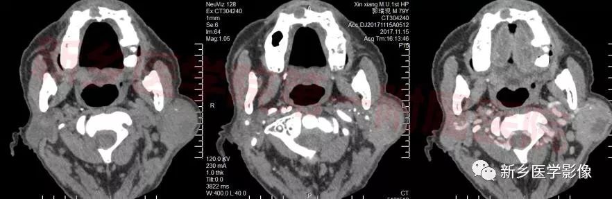 【病例】79岁男性腮腺和盆腔同时长肿瘤,怎么回事? 【病例】79岁男性腮腺和盆腔同时长肿瘤,怎么回事?