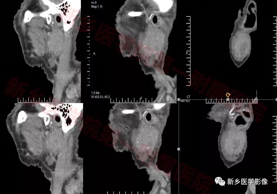 【病例】79岁男性腮腺和盆腔同时长肿瘤,怎么回事? 【病例】79岁男性腮腺和盆腔同时长肿瘤,怎么回事?