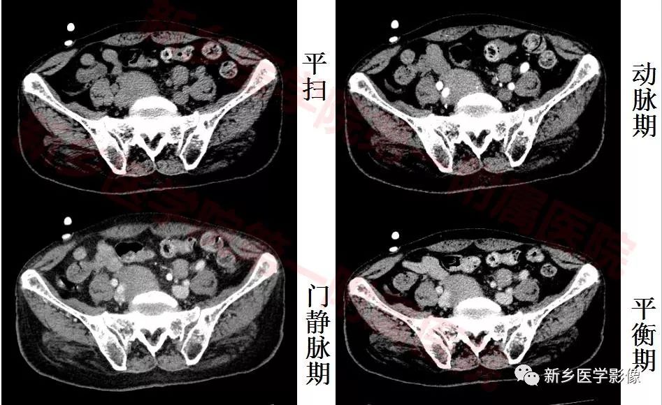 【病例】79岁男性腮腺和盆腔同时长肿瘤,怎么回事? 【病例】79岁男性腮腺和盆腔同时长肿瘤,怎么回事?