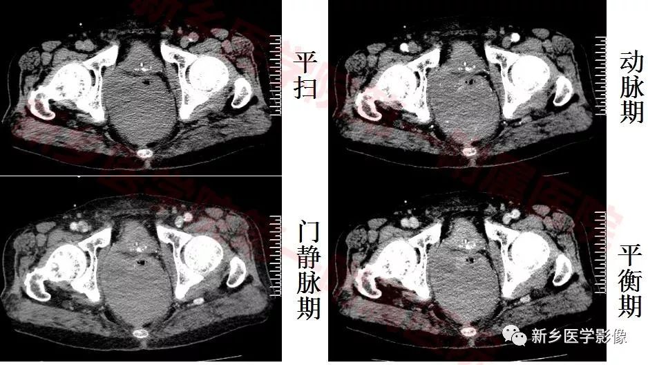 【病例】79岁男性腮腺和盆腔同时长肿瘤,怎么回事? 【病例】79岁男性腮腺和盆腔同时长肿瘤,怎么回事?