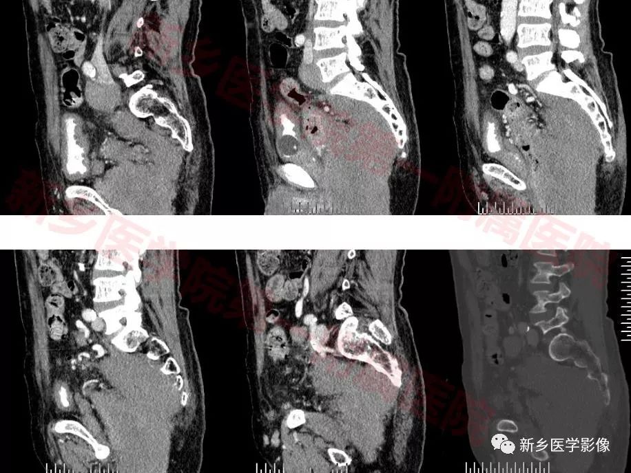 【病例】79岁男性腮腺和盆腔同时长肿瘤,怎么回事? 【病例】79岁男性腮腺和盆腔同时长肿瘤,怎么回事?