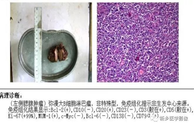 【病例】79岁男性腮腺和盆腔同时长肿瘤,怎么回事? 【病例】79岁男性腮腺和盆腔同时长肿瘤,怎么回事?