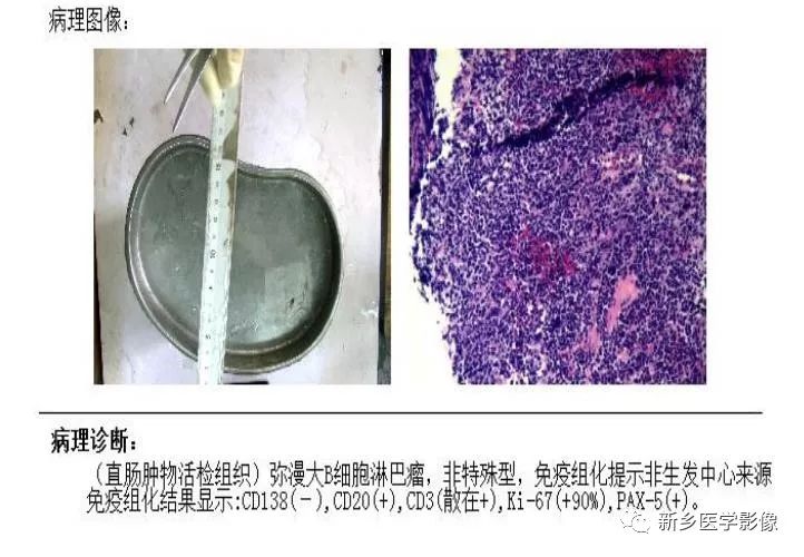 【病例】79岁男性腮腺和盆腔同时长肿瘤,怎么回事? 【病例】79岁男性腮腺和盆腔同时长肿瘤,怎么回事?