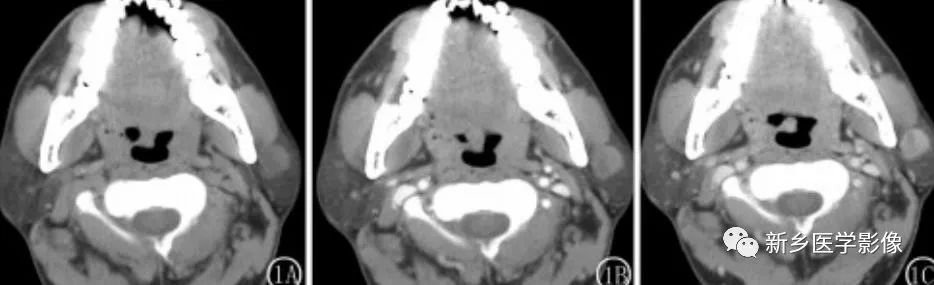 【病例】79岁男性腮腺和盆腔同时长肿瘤,怎么回事? 【病例】79岁男性腮腺和盆腔同时长肿瘤,怎么回事?